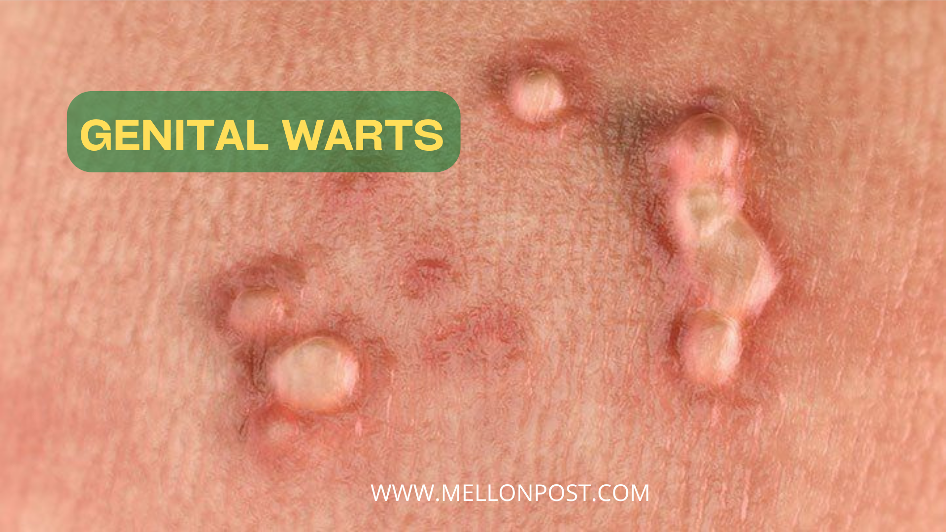 Genital Warts Symptoms, Causes, and  Treatments