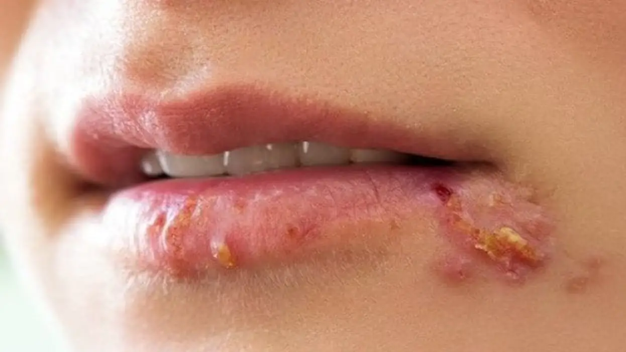 Herpes Treatment: 20 Home Remedies for Managing Outbreaks