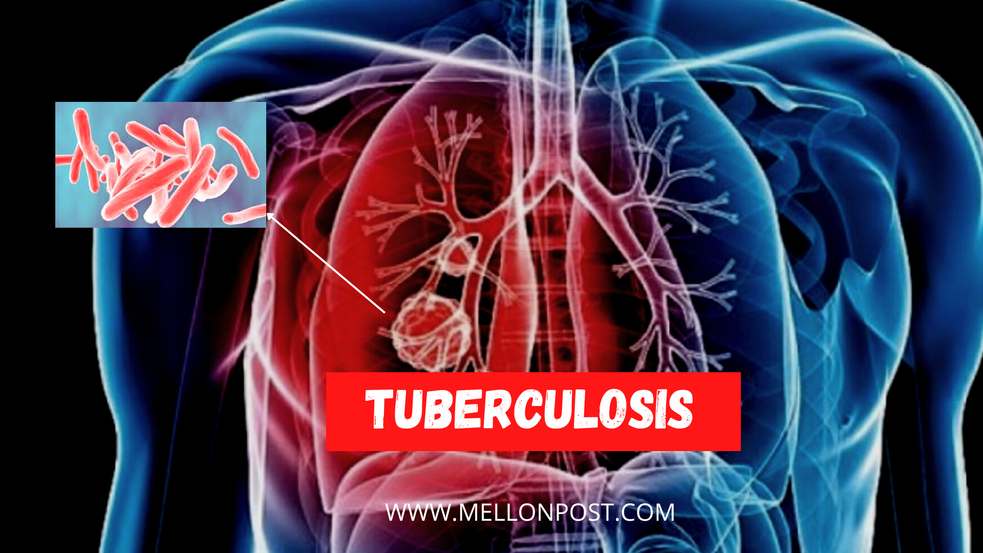 Tuberculosis: Causes, Symptoms, and Treatment