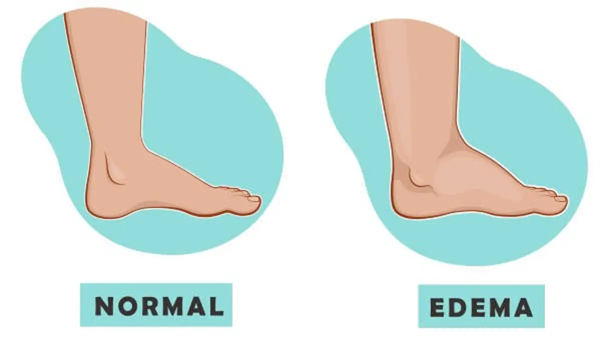 edema: swollen and a normal leg