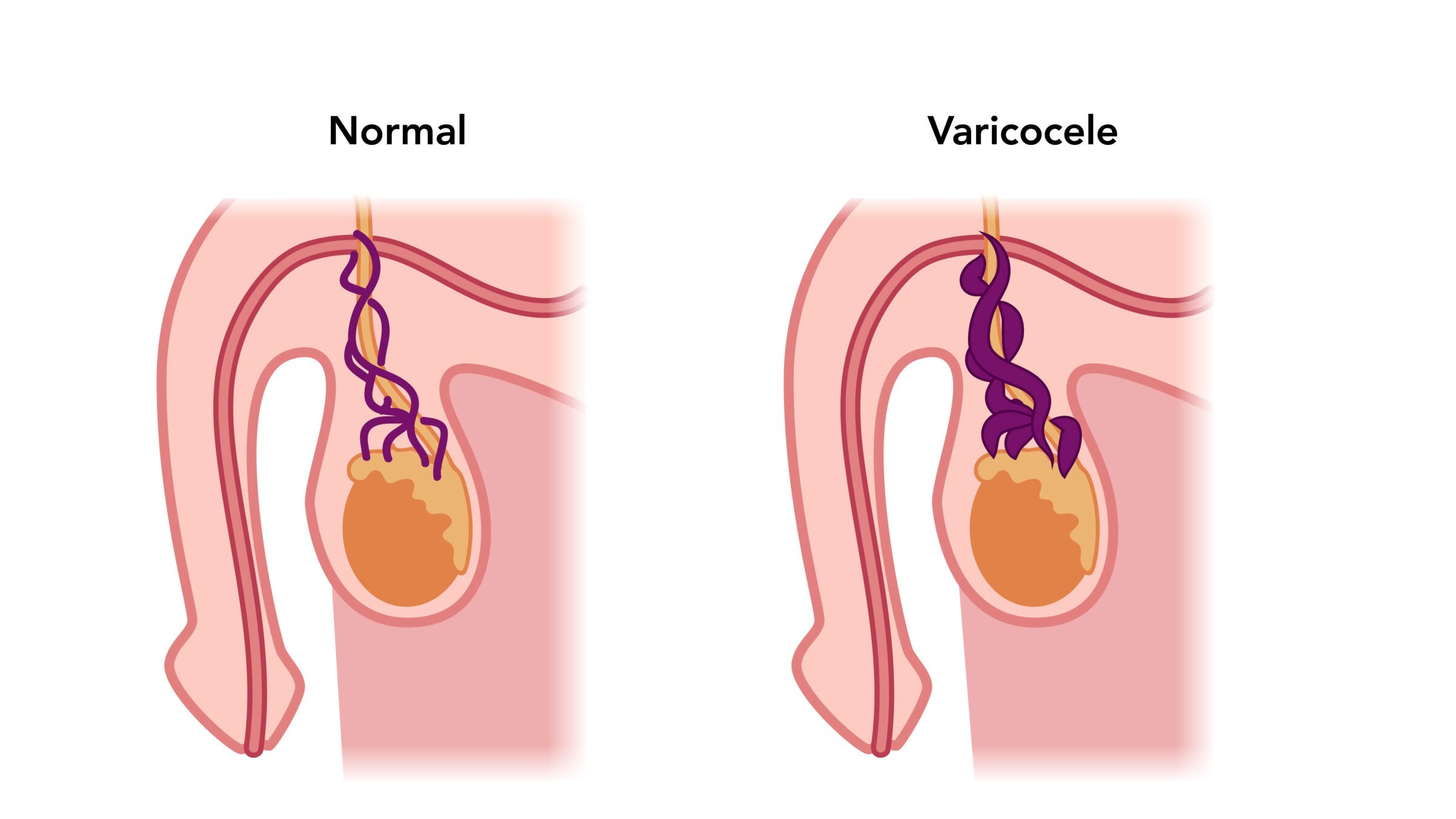 What is Varicocele, its symptoms, causes and treatment