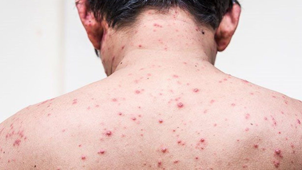 Quick And Effective Treatment For Chickenpox