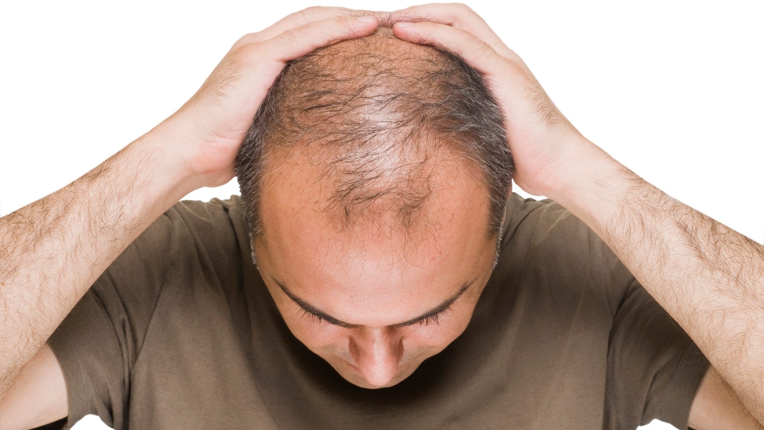 Hair Loss Treatment and Struggles