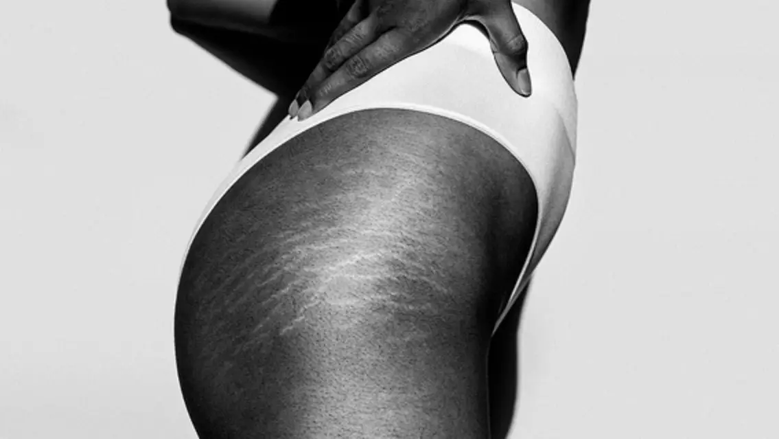 How to Overcome The Nightmares of Stretch Marks