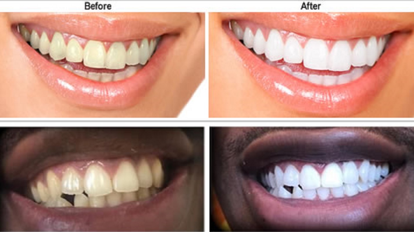 Find Out The Secrets of Teeth Whitening