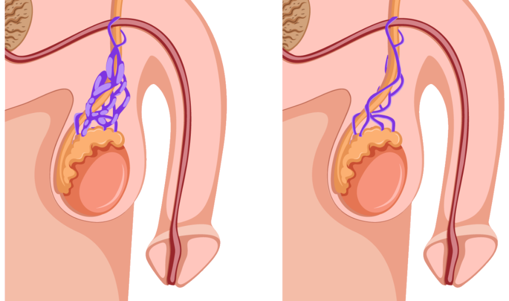 varicocele