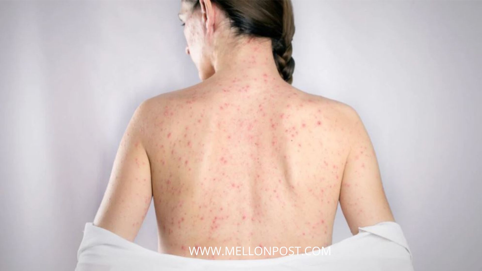 Popular Causes of Measles Symptoms, Complications and Treatment
