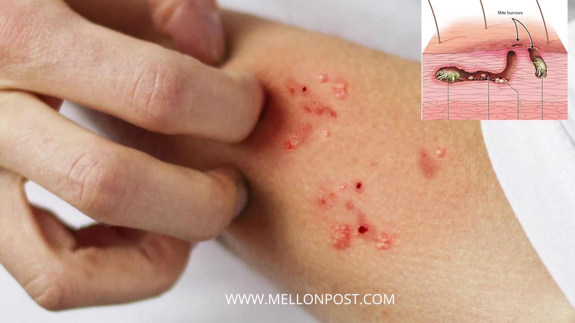 treatments of scabies