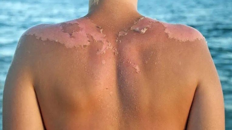 The Dangers Of Sunburn And How To Get Protections