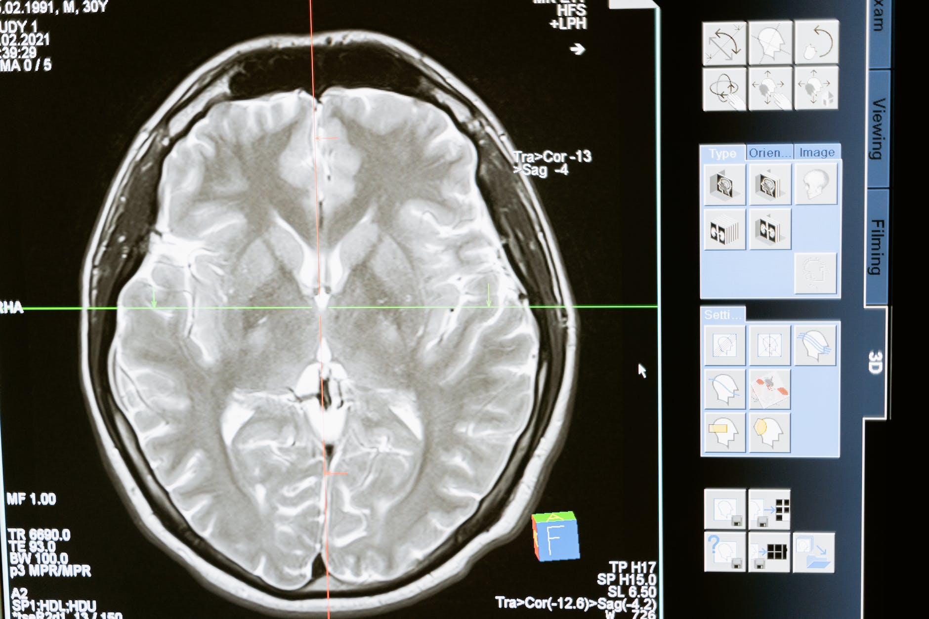What Is A Brain Tumor Symptoms, Causes And Treatments?