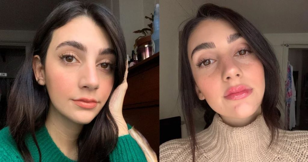 Lip Injections Before and After