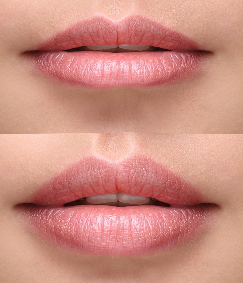 Lip augmentation Before and After