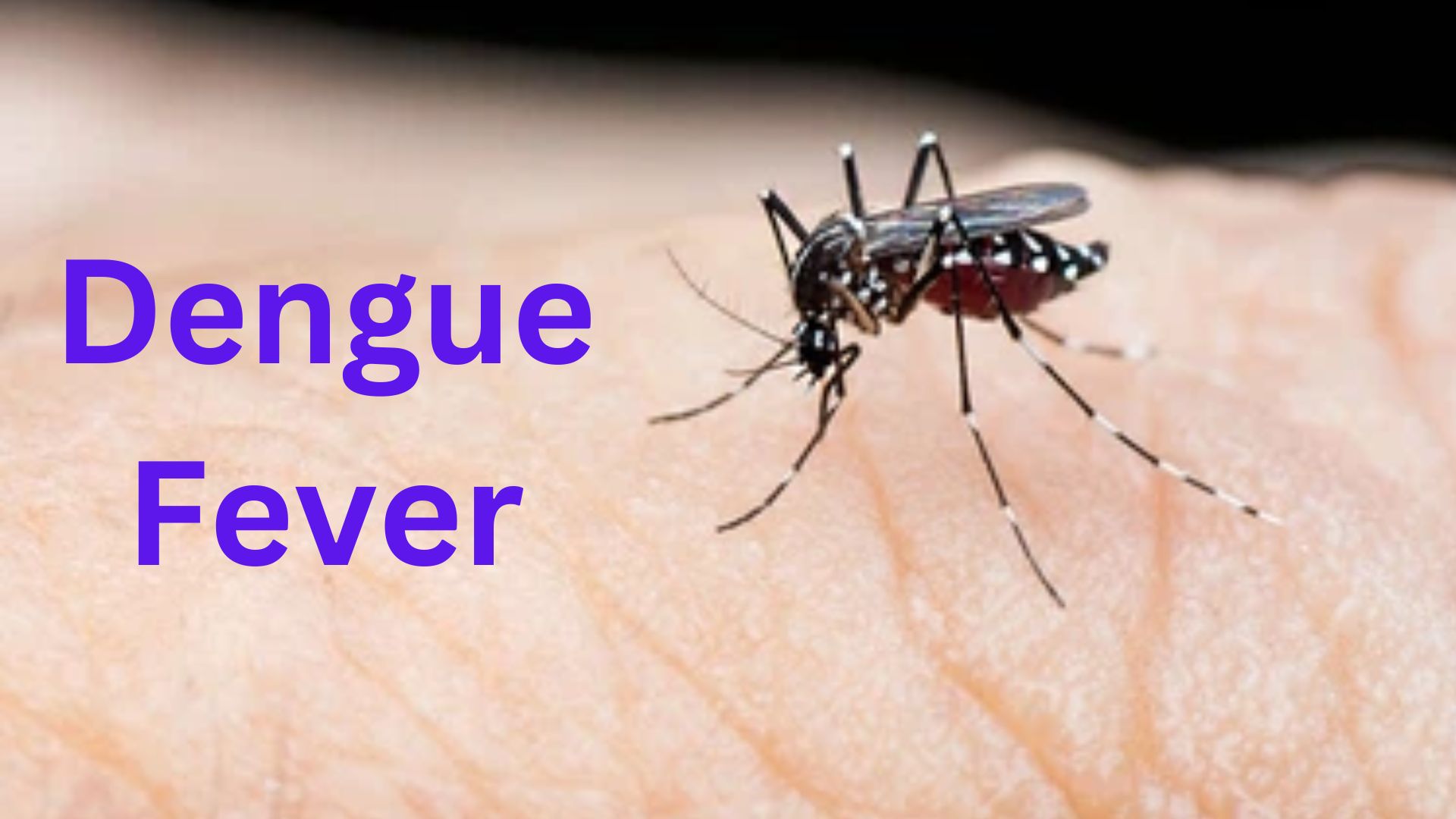 Dengue Fever: Causes, Symptoms, Prevention, and Treatment