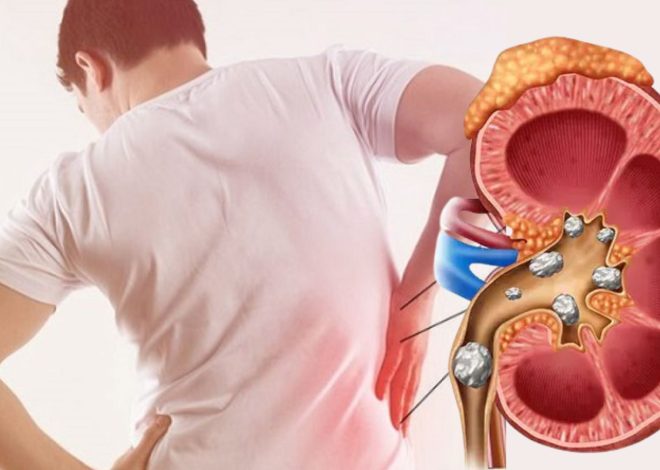 Kidney Stones: Causes, Symptoms, Prevention, and Treatment