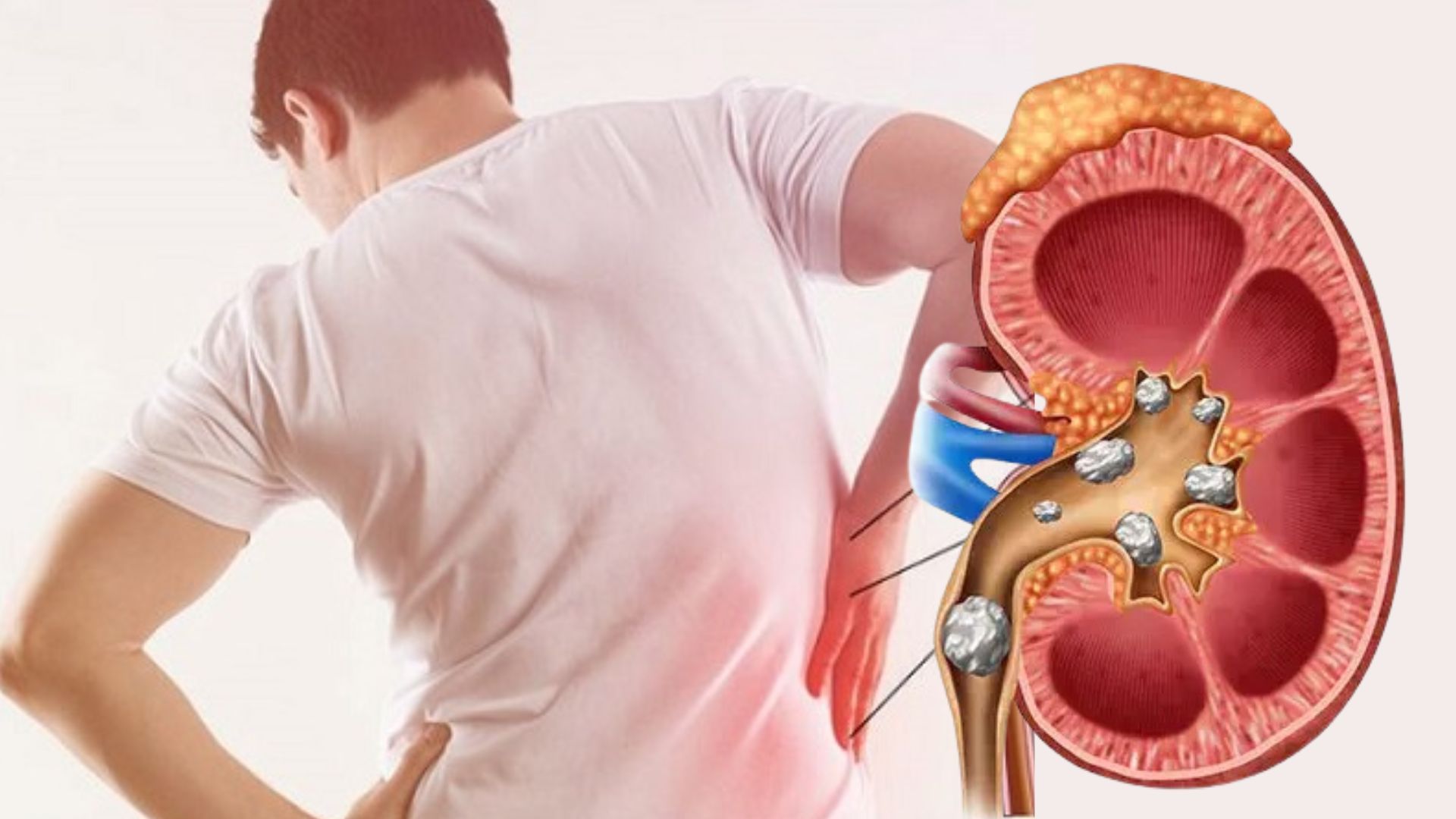 Kidney Stones: Causes, Symptoms, Prevention, and Treatment