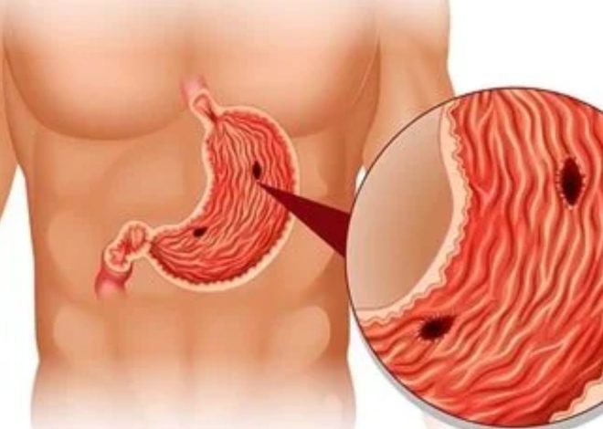 Ulcers: Types, Causes, Symptoms, Prevention, and Treatment