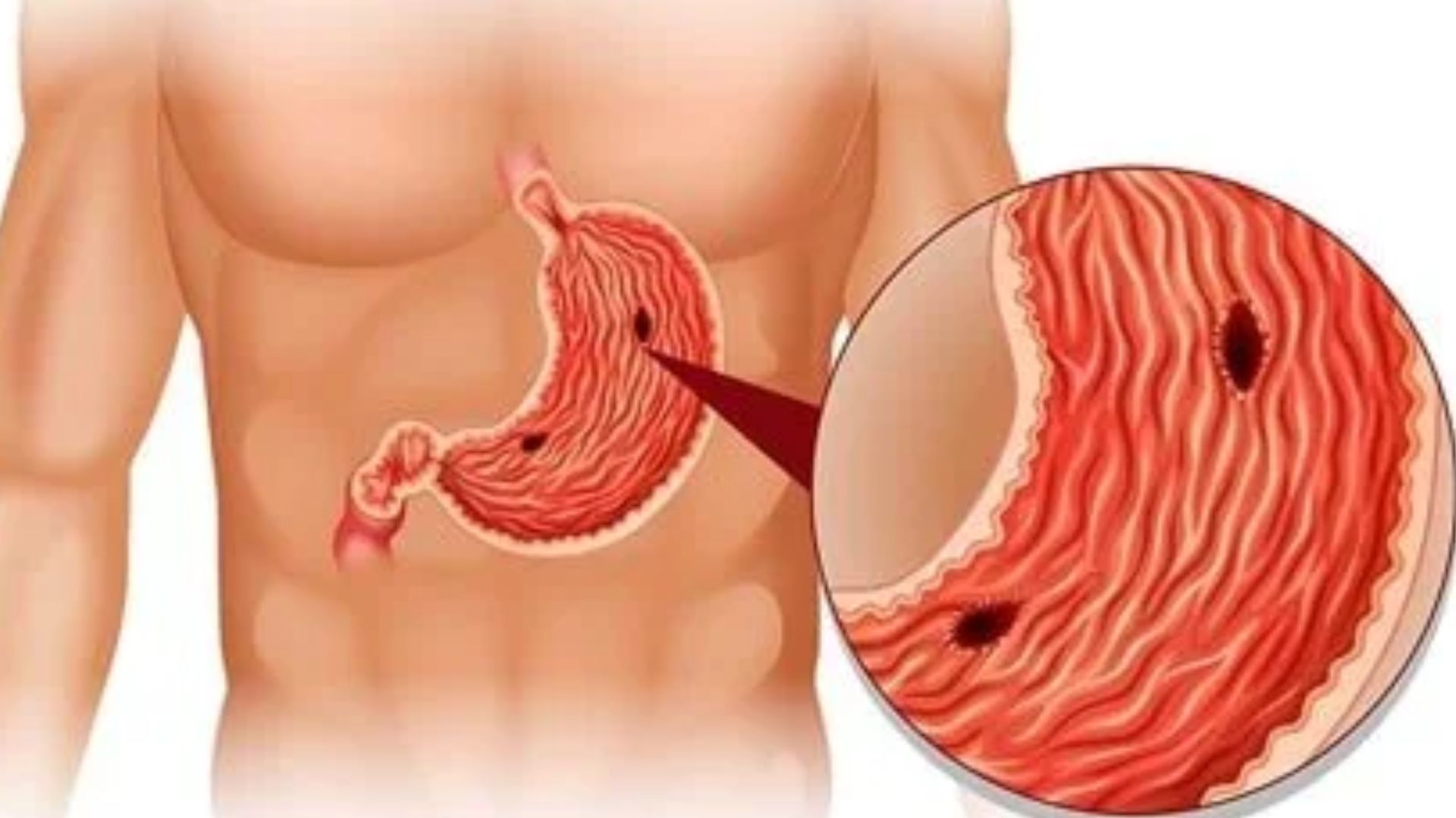 Ulcers: Types, Causes, Symptoms, Prevention, and Treatment