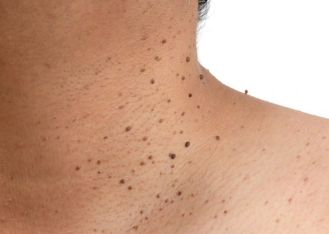 How to Remove Skin Tags: Procedures and Effects