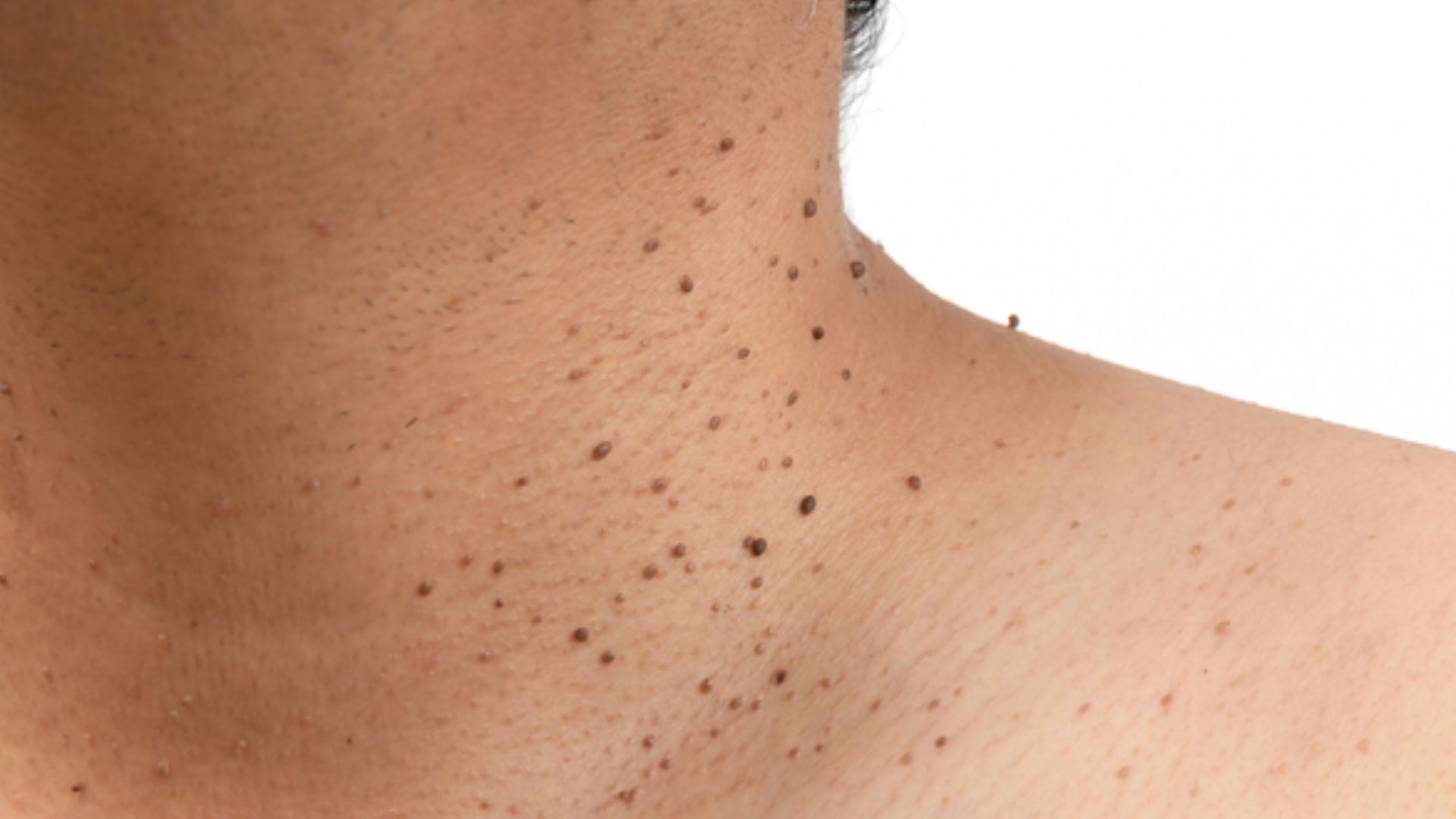 How to Remove Skin Tags: Procedures and Effects